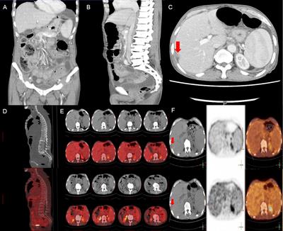 Fluid overload–associated large B-cell lymphoma with primary biliary cirrhosis: A case report